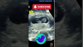 Fetal ultrasound of 10 weeks 6 days _ Mother thinks it's baby boy moving #pregnancy #ultrasound #yt