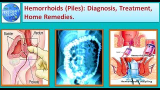 Hemorrhoids Piles Diagnosis, Treatment