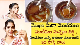 How to Get Rid Pimples, Acnes at Home in Telugu/Cinnamon Face Mack for Pimples, Acens@trendy ramya