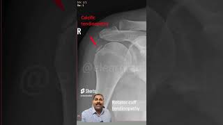 Severe shoulder pain