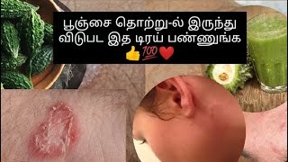 Ringwarms-ஆ..அப்போ கண்டிப்பா இது ட்ரை பண்ணுங்க..100%சூப்பர் ரெமிடி❤️💯👍