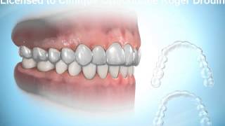 Invisalign  Roger Drouin orthodontiste certifié