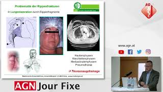 Thoraxtrauma- Basics and Pitfalls - Lindenmann