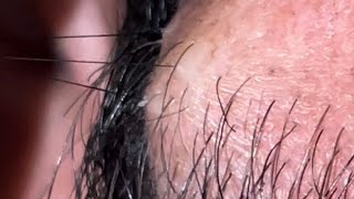 Ingrown 10 Ingrown is live now asmr