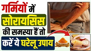 Psoriasis ki khujli ka ilaj | सोरायसिस में खुजली को दूर करने के उपाय | Psoriasis ka ilaj kya hai