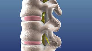 Lumbar Radiculopathy