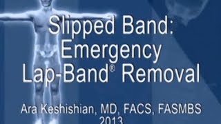 Slipped Band: Emergency Lap-Band® Removal