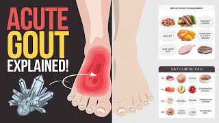 Acute Gout: Causes, Symptoms, and Effective Remedies@bestdoctor