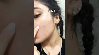 😌Remove pimple in overnight permanently/Overnight Acne Treatment #ytshorts #viralvedios #acneremoval