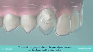 Smiletech Extrusion Elastic