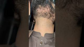 Clearly ingrown hairs removed problem #hairsalon #barbersurgion #beard #hairstyle #barber