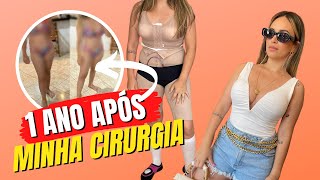 1 ano após Abdominoplastia e Mamoplastia