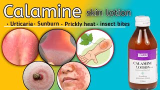 calamine lotion|calamine lotion kis kaam aati hai|calamine skin lotion ke fayde|mkpk