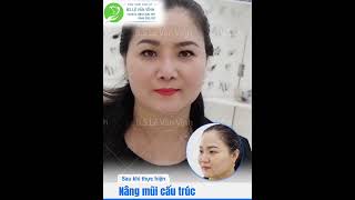 Nâng Mũi Cấu Trúc Có Mấy Loại - Thẩm Mỹ Khang Vĩnh