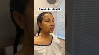 62 Year Old Facelift 🤯 Insane Results 6 Months Post-Op