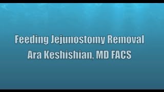 Feeding Jejunostomy Removal