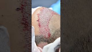 HAIR TRANSPLANT AFTER 10 DAYS | HAIR TRANSPLANT RESULT