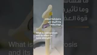 What is Osteoporosis and its effects on bone strength? | Dr. Katarina Simic | Reem Hospital