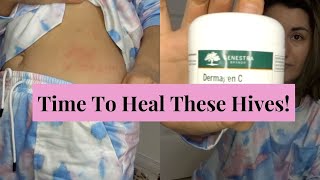 Supplements for Hives | Still breaking out!