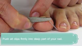 How to use “NailLift”-Ingrown toenail correction device