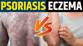 Eczema vs psoriasis | Difference Eczema And Psoriasis | क्या है एक्जिमा और सोरायसिस में अंतर