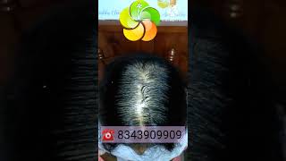 Hair loss Treatment For Women | PRP treatment Results | #shorts