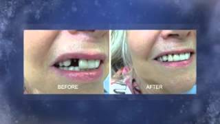 Dental Implants London