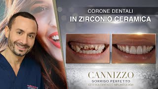 Corone Dentali del Dr. Cannizzo