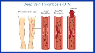 Deep Vein Thrombosis DVT