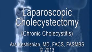 Laparoscopic Cholecystectomy - Chronic Cholecystitis