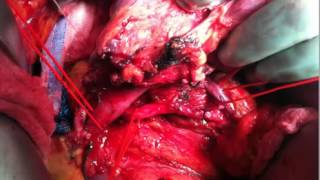 The Whipple Procedure with Portal Vein Resection