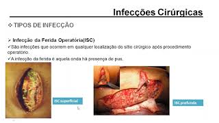 Infecções Cirúrgicas