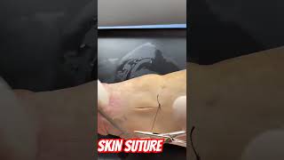 SKIN SUTURE || SIMPLE INTERRUPTED SUTURE || SURGICAL SUTURE || #surgeryeducation #sutureremoval