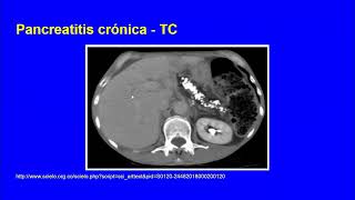 Pancreatitis crónica y cáncer de páncreas