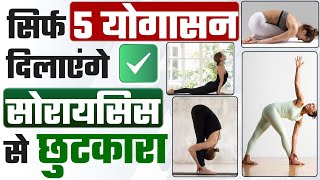 Benefits of Yoga | Psoriasis Yoga | योगा से होगा सोरायसिस का जबरदस्त इलाज | Psoriasis cure