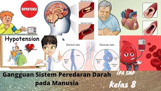 Gangguan sistem peredaran darah pada manusia || IPA SMP kelas 8