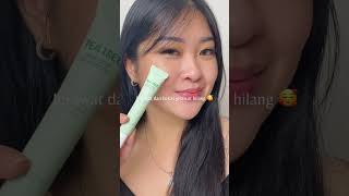 ACNE SPOT REMOVAL YANG AMPUH MEREDAKAN JERAWAT DAN MEMUDARKAN BEKAS JERAWAT 😍😍