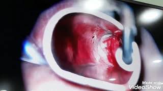 Surgical removal of #Polyp on vocal cord