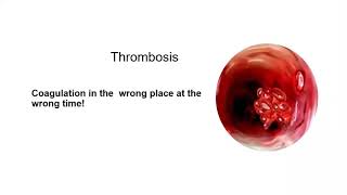 Thrombosis – One of the causes of recurrent miscarriages