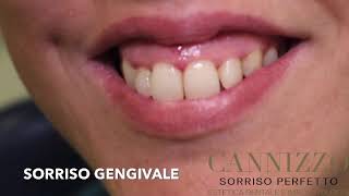 SORRISO GENGIVALE - Gummy smile