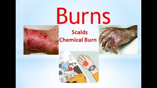 Burns scalds chemical burns