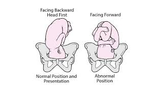 Why did I have a cesarean delivery even though my pregnancy was normal. I even got labor pains.