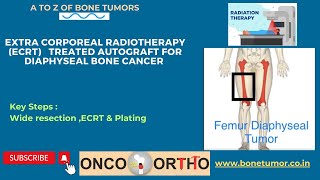 Femur or Thigh Bone or Diaphysis Tumor Surgery: Radiotherapy treated Autograft reconstruction