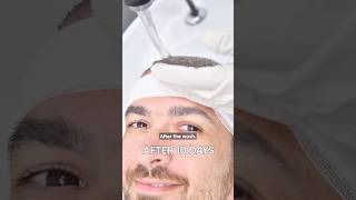 My Experience With Hair Transplant | Stefano After 45 Days OF Hair Transplant