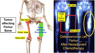 Total Femur or Thigh bone Replacement  by Total Femur Megaprosthesis What is it & Functional outcome