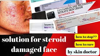 cure for fairness cream and steroid damaged face/ how to stop skinshine/skinlite/ betnovate creams /