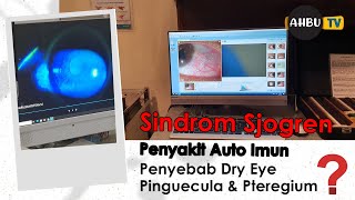 SINDROM SJOGREN AUTO IMUN PENYEBAB DRY EYE, PINGUECULA, PTEREGIUM