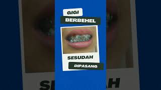 Pasang Behel Gigi