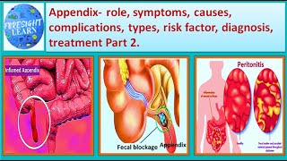 Appendix role, Symptoms, causes, types, Risk factor, diagnosis, treatment Part 2