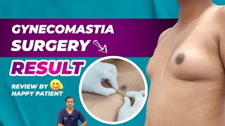 Gynecomastia Surgery Result | Review by Happy Patient | Dr. Neeraj Bhaban